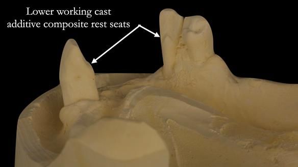 Finlay's Case Study Newsletter 40 - Immediate Mk 1 RPD to Definitive Mk 2 RPD - full protocol