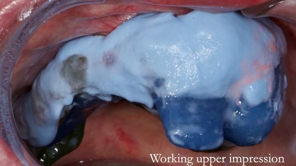 Newsletter 55 Provision of metal based partial dentures for Zephyrine with a repaired cleft lip and palate