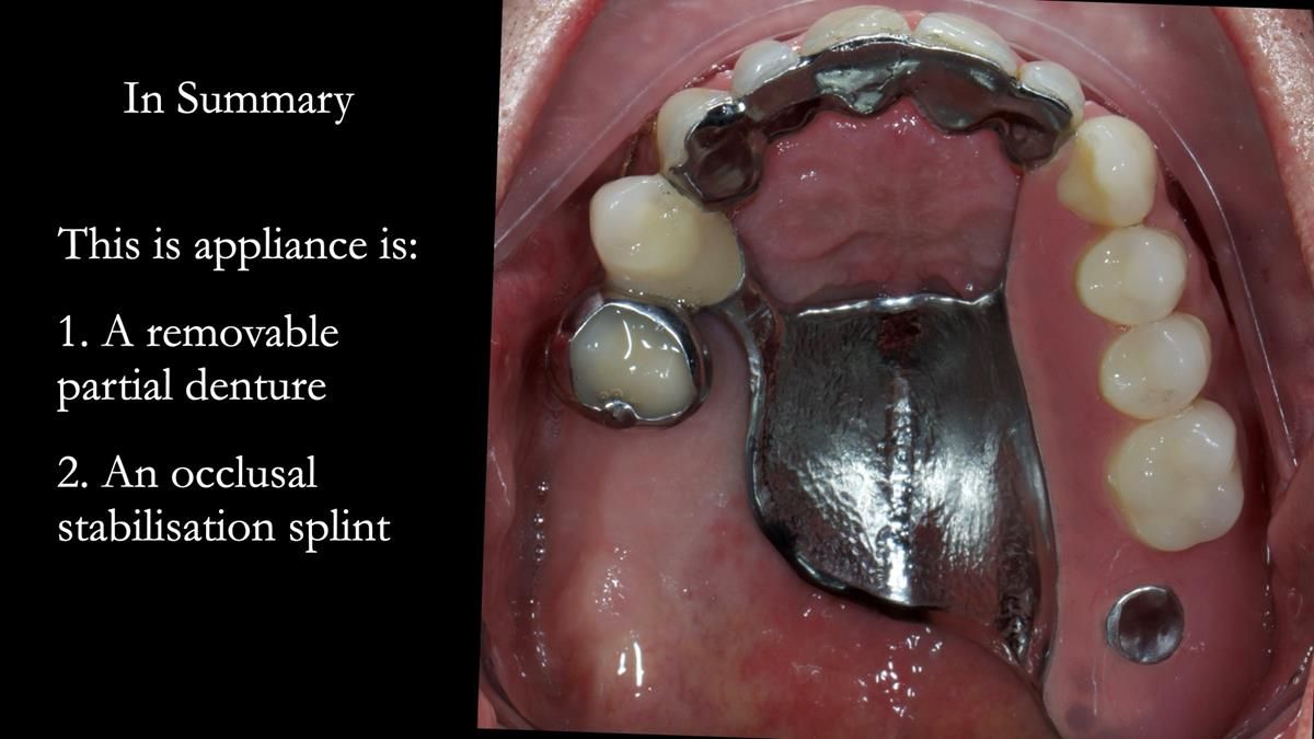 Newsletter 89 – Simon: A Challenging Kennedy Class II Division 1 Upper CoCr Partial Denture with a High Smile Line