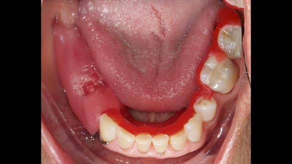 Finlay's Newsletter 61 provision of a lower unilateral free end saddle metal based partial denture for Joyce