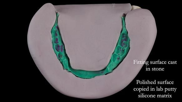 Replacing Madeline’s Complete denture FULL PROTOCOL