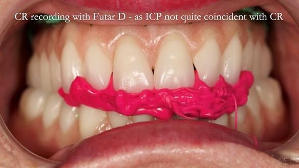 Replacing Madeline’s Complete denture FULL PROTOCOL
