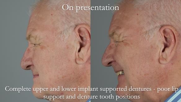 Newsletter 57 showcases the making and fitting process of implant-supported complete dentures for Alisdair