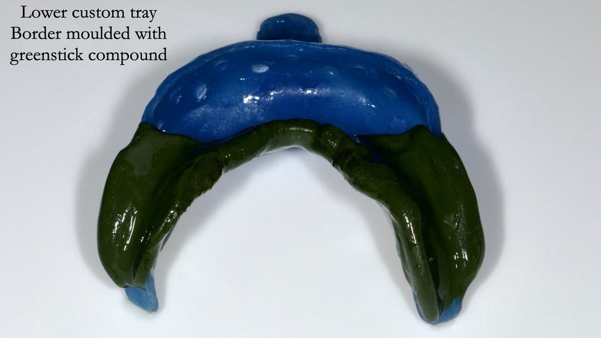 Newsletter 87 – Father Peter: A Partial Denture that needed Minor Miracle