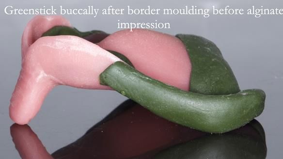 Newsletter 54 case presentation upper complete denture and lower Scandinavian designed hygienic partial denture for David