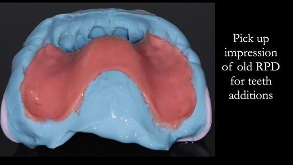 Finlay's Newsletter 62 provision of extractions and metal based complete dentures for Rafique