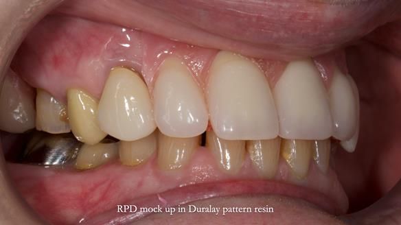 Newsletter 81 - Pam’s Story — how a partial denture changed her life (+ live walkthrough this Thursday)
