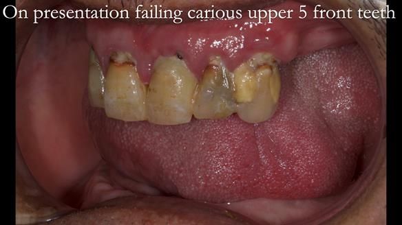 Finlay's Newsletter 62 provision of extractions and metal based complete dentures for Rafique