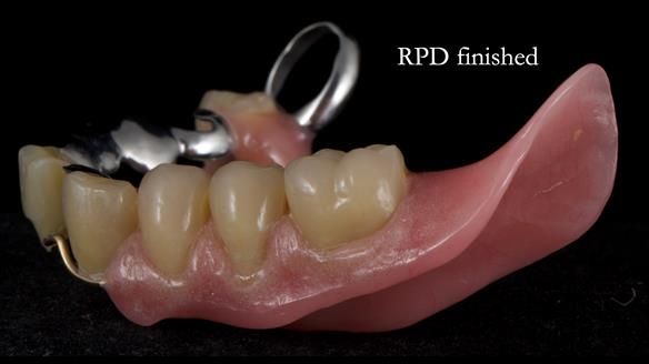 Newsletter 55 Provision of metal based partial dentures for Zephyrine with a repaired cleft lip and palate