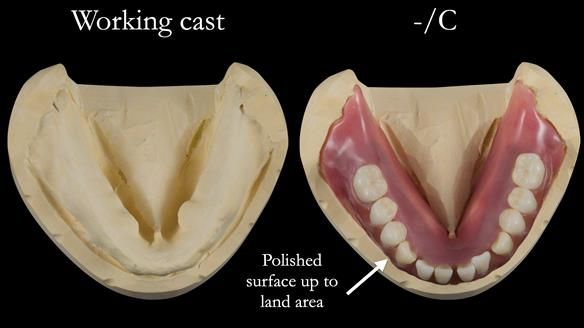 Newsletter 53 showing the making and fitting of ultra life-like dentures for Valena