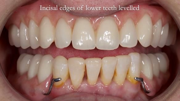 Newsletter 52 Managing Jo’s failing dentition with extractions and Mk 1/Mk 2 complete upper dentures and lower partial dentures FULL PROTOCOL