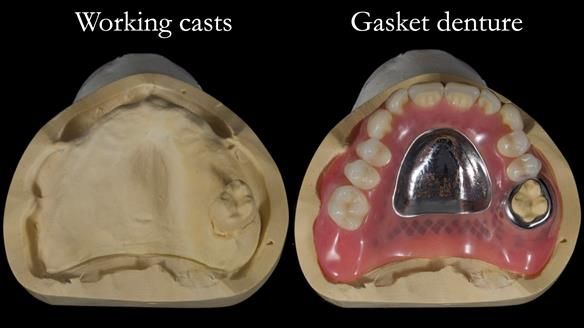 Finlay's Newsletter 58 Gasket upper partial denture for Zoe