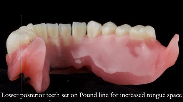 Managing poor implant positioning with complete dentures and Locator attachments - full protocol Newsletter 41