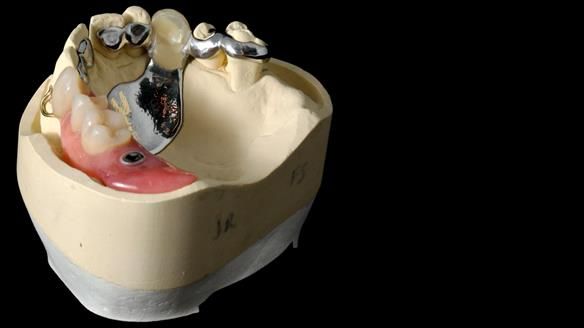 Newsletter 86 Peter the Architect — precision removable partial dentures case study