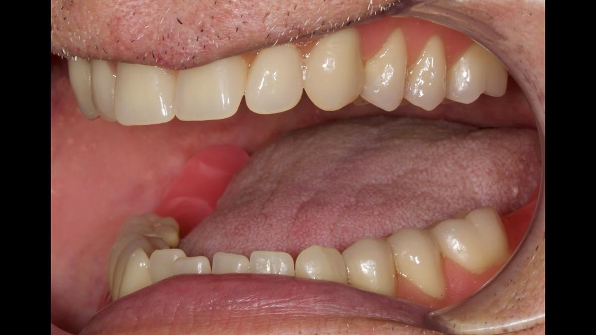 Fin’s Newsletter 88 — Complete dentures - full protocol… he rearranged his own teeth!