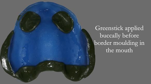 Newsletter 53 showing the making and fitting of ultra life-like dentures for Valena