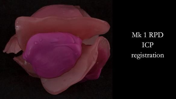 Finlay's Case Study Newsletter 40 - Immediate Mk 1 RPD to Definitive Mk 2 RPD - full protocol