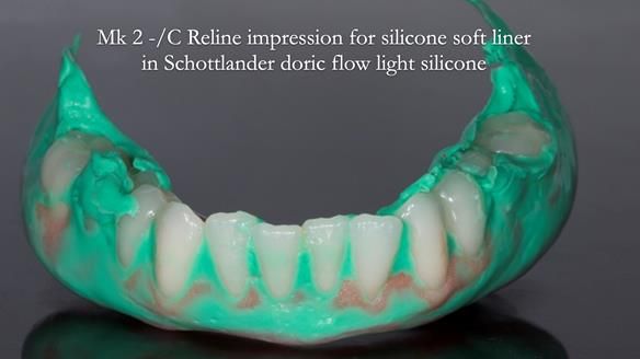 Replacing Madeline’s Complete denture FULL PROTOCOL