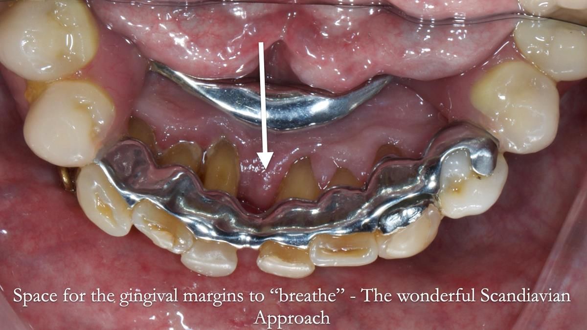 Newsletter 87 – Father Peter: A Partial Denture that needed Minor Miracle