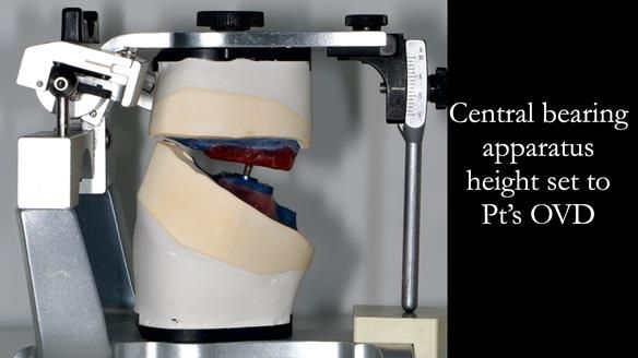 Newsletter 78: What do Clark Gable and a Locator® overdenture have in common?