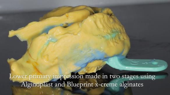 Finlay's Newsletter 61 provision of a lower unilateral free end saddle metal based partial denture for Joyce