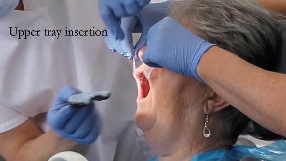 Replacing Madeline’s Complete denture FULL PROTOCOL