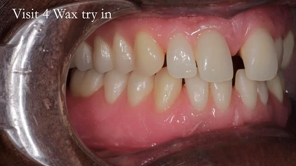 Newsletter 53 showing the making and fitting of ultra life-like dentures for Valena