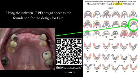 Newsletter 81 - Pam’s Story — how a partial denture changed her life (+ live walkthrough this Thursday)