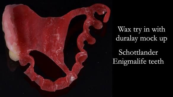 Finlay's Newsletter 64 case study - provision of a Kennedy class 2 metal based Scandinavian RPD for Ian