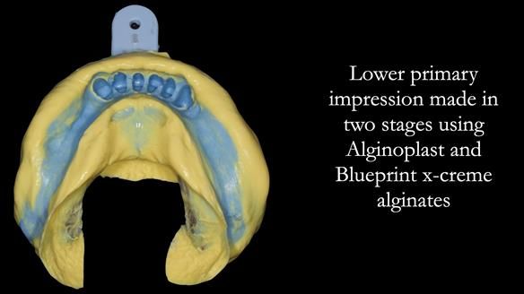 Newsletter 52 Managing Jo’s failing dentition with extractions and Mk 1/Mk 2 complete upper dentures and lower partial dentures FULL PROTOCOL