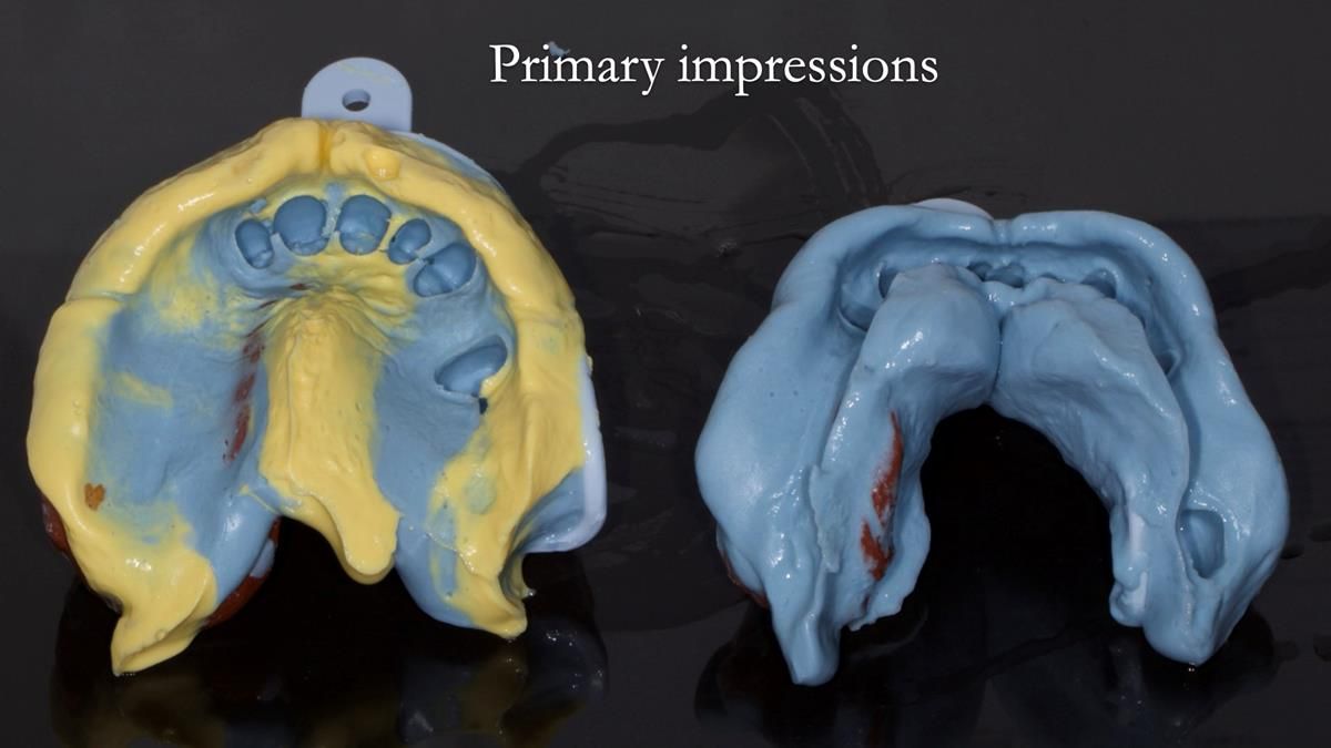 Newsletter 89 – Simon: A Challenging Kennedy Class II Division 1 Upper CoCr Partial Denture with a High Smile Line