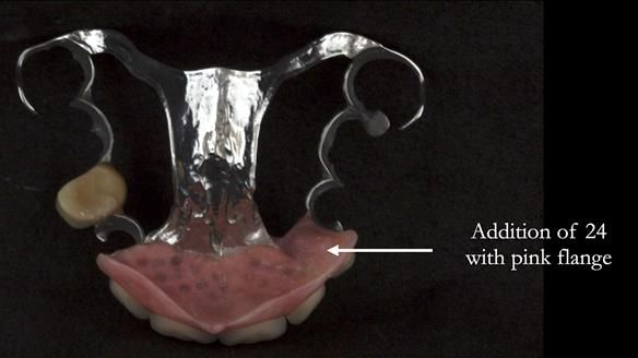 Finlay's Newsletter 63 Case study provision of metal based Scandinavian RPD - functional 10 years on