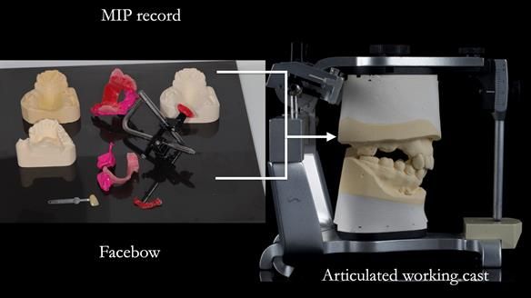Finlay's Newsletter 60 Sylvia's upper Kennedy Class 2 Mod 1 metal based upper RPD