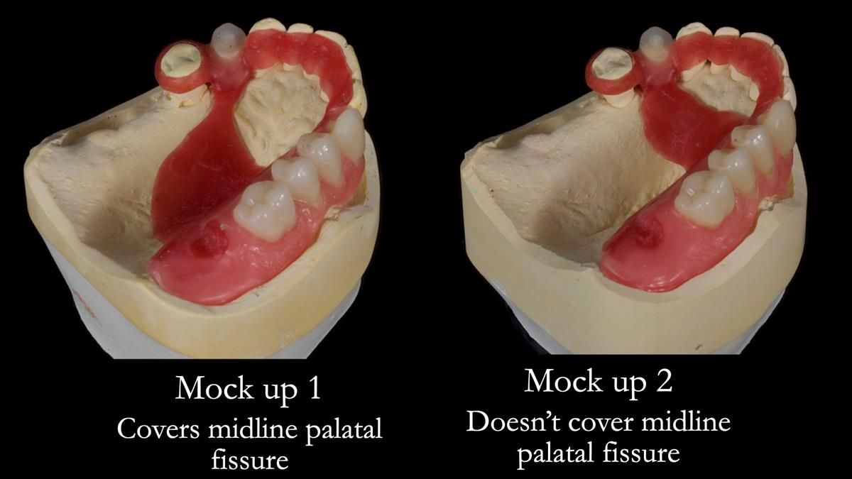 Newsletter 89 – Simon: A Challenging Kennedy Class II Division 1 Upper CoCr Partial Denture with a High Smile Line