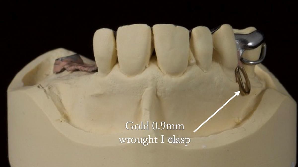 Newsletter 89 – Simon: A Challenging Kennedy Class II Division 1 Upper CoCr Partial Denture with a High Smile Line