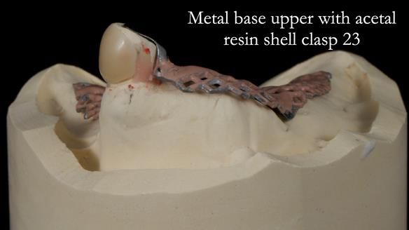 Newsletter 55 Provision of metal based partial dentures for Zephyrine with a repaired cleft lip and palate