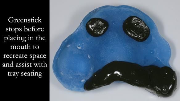 Finlay's Newsletter 58 Gasket upper partial denture for Zoe