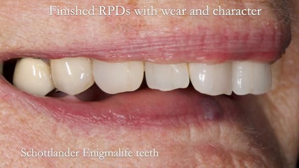 Eileen's transformation with upper and lower RPDs of Scandinavian hygienic design FULL PROTOCOL