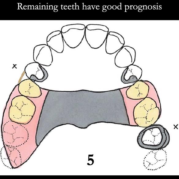 Universal Scandinavian partial denture designs