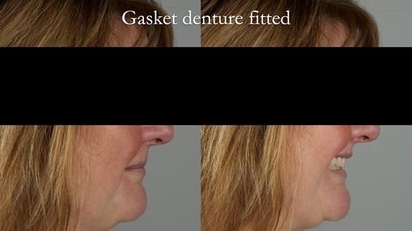 Finlay's Newsletter 58 Gasket upper partial denture for Zoe