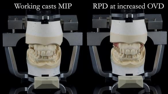Finlay's Newsletter 60 Sylvia's upper Kennedy Class 2 Mod 1 metal based upper RPD
