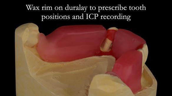 Finlay's Case Study Newsletter 40 - Immediate Mk 1 RPD to Definitive Mk 2 RPD - full protocol