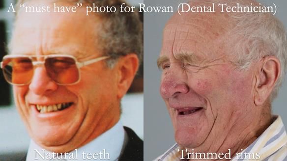 Complete denture Class II div 2 deep overbite Newsletter 39