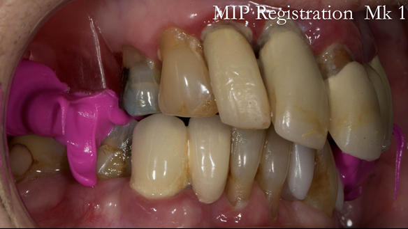Figure 22 Registration visit with wax rim - teeth in maximum intercuspation - recorded with Futar D