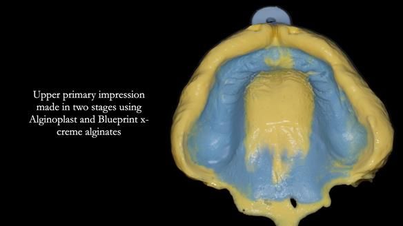 Newsletter 78: What do Clark Gable and a Locator® overdenture have in common?