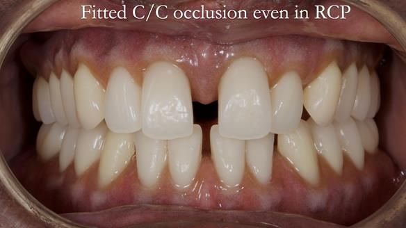 Newsletter 53 showing the making and fitting of ultra life-like dentures for Valena