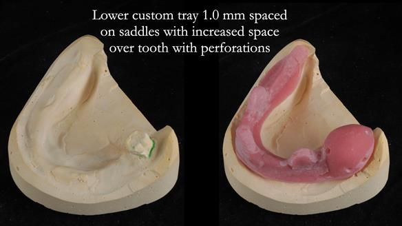 Finlay's Newsletter 59 Ultra hard partial dentures made for Gill