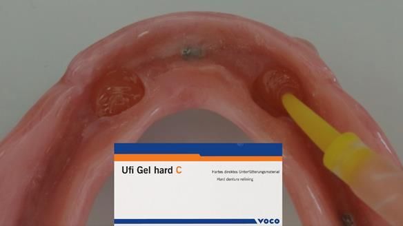 Newsletter 78: What do Clark Gable and a Locator® overdenture have in common?