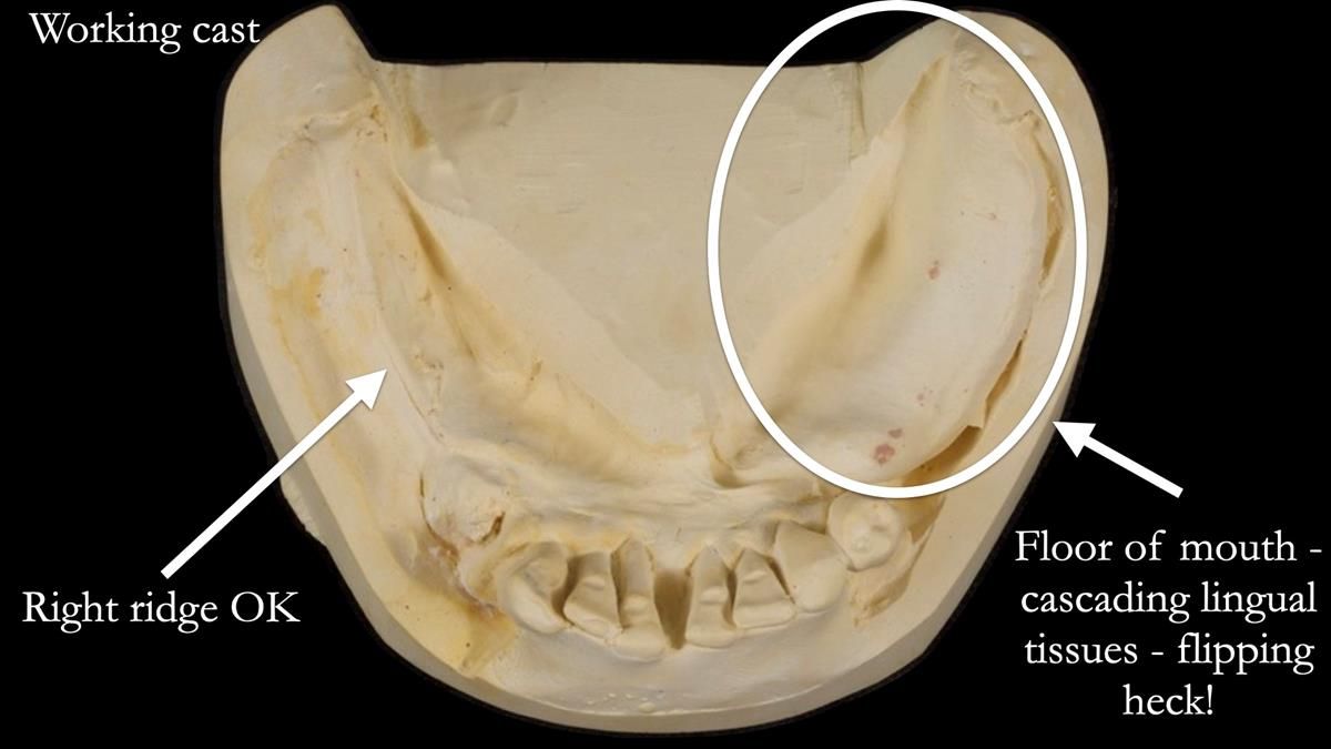 Newsletter 87 – Father Peter: A Partial Denture that needed Minor Miracle
