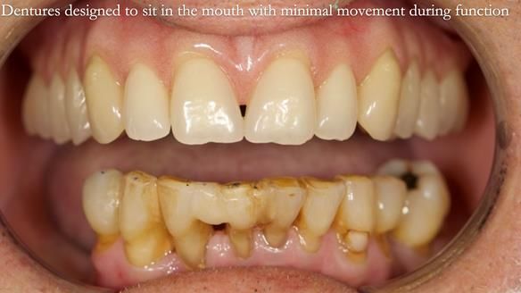 Newsletter 54 case presentation upper complete denture and lower Scandinavian designed hygienic partial denture for David
